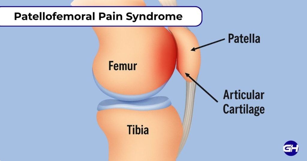 Patellofemoral Pain Syndrome (PFPS) is a common issue also referred to as runner's knee or moviegoer's knee. 